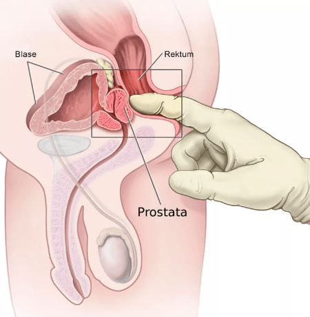 Prostatos masažas